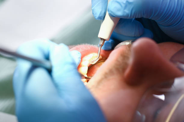 Best Emergency Dentist for Lost Fillings or Crowns in Henderson, TN